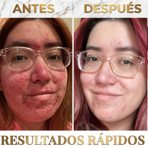 ACNEFRENO™