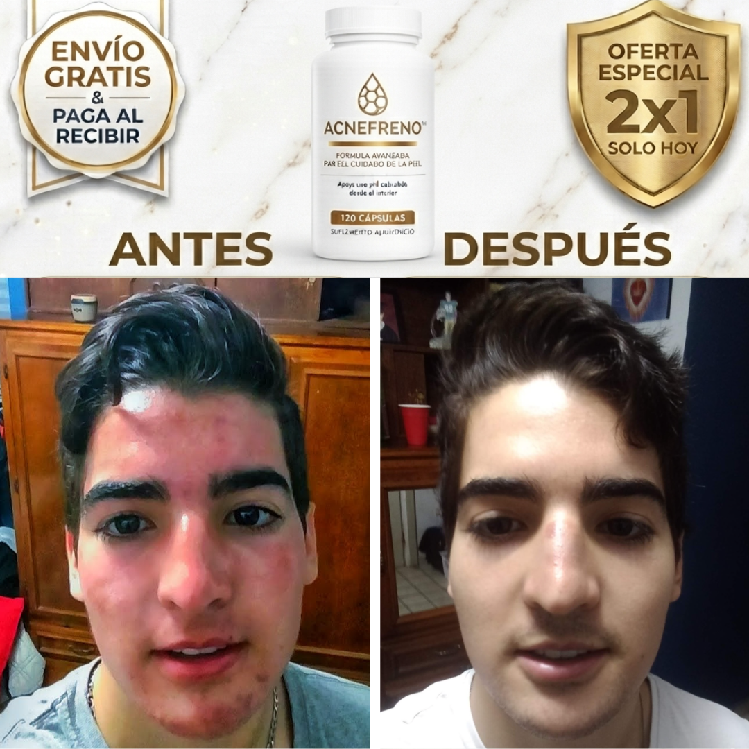 ACNEFRENO™