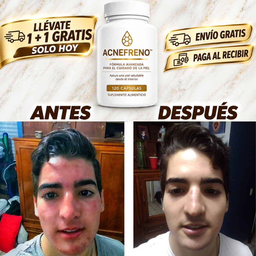 ACNEFRENO™